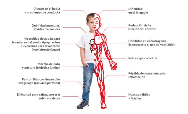 Jumilla lanzará globos para concienciar sobre el síndrome de Duchenne